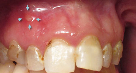درمان عفونت و آبسه دندان