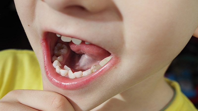 دندانپزشک کودکان اصفهان |دندان کوسه ای یا رویش دندان دائمی پشت دندان شیری