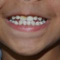 پیشگیری از فلوروزیس در کودک | دندانپزشک کودکان اصفهان