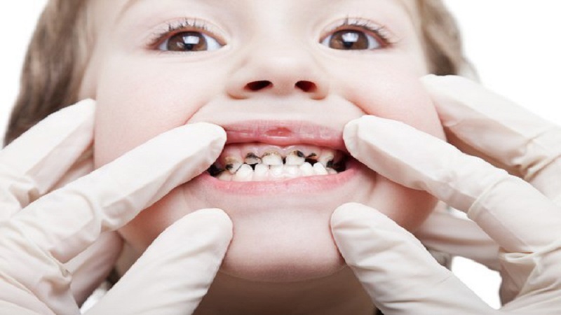 سیاه شدن دندان کودکان | دندانپزشک کودکان اصفهان