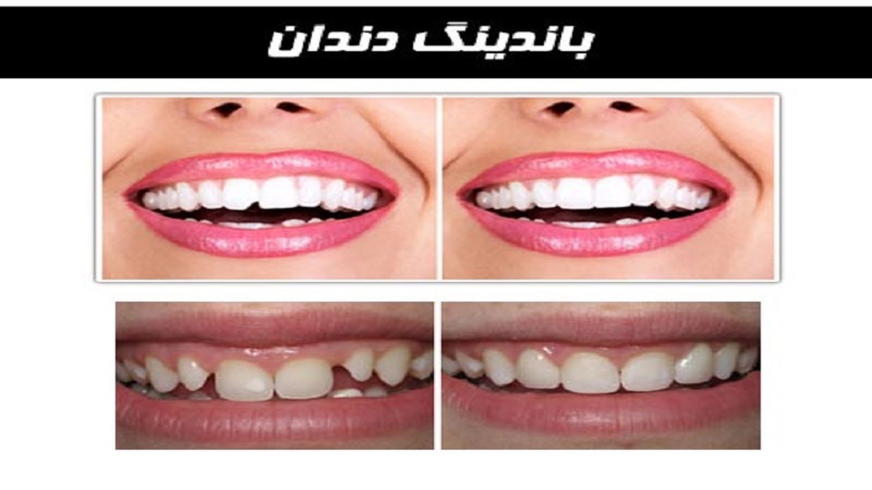 باندینگ دندان چیست | دندانپزشک کودکان اصفهان