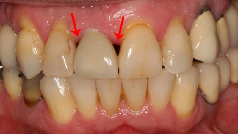 مثلث سیاه بین دندانی | دندانپزشک کودکان اصفهان