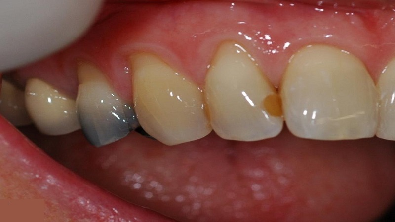 سیاه شدن بین دو دندان | دندانپزشک کودکان اصفهان