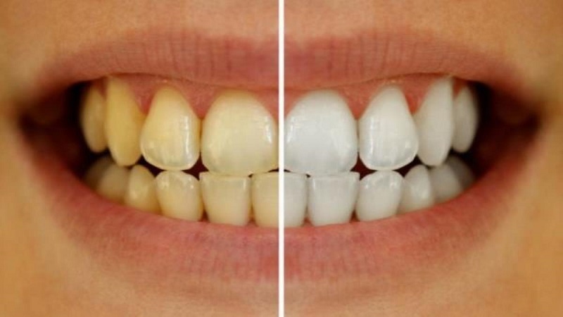 علل و انواع تغییر رنگ دندان | دندانپزشک کودکان اصفهان