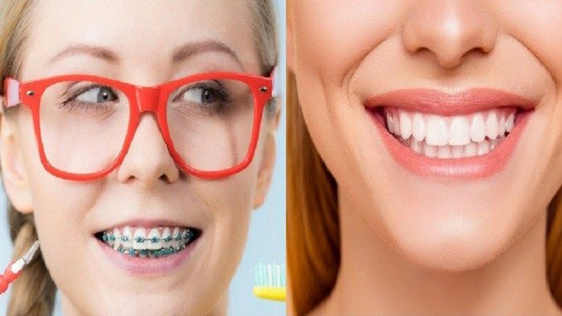 ارتودنسی بهتر است یا لمینت دندان؟ | دندانپزشک کودکان اصفهان
