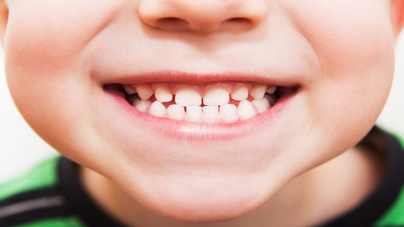لکه سفید روی دندان کودکان | دندانپزشک کودکان اصفهان