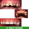 Root canal treatment and front and back teeth restoration under anesthesia | Isfahan Children's Dentist,,fa,What is pulp?,,fa,How to make a child happy with dentistry?,,fa,August 23,,fa