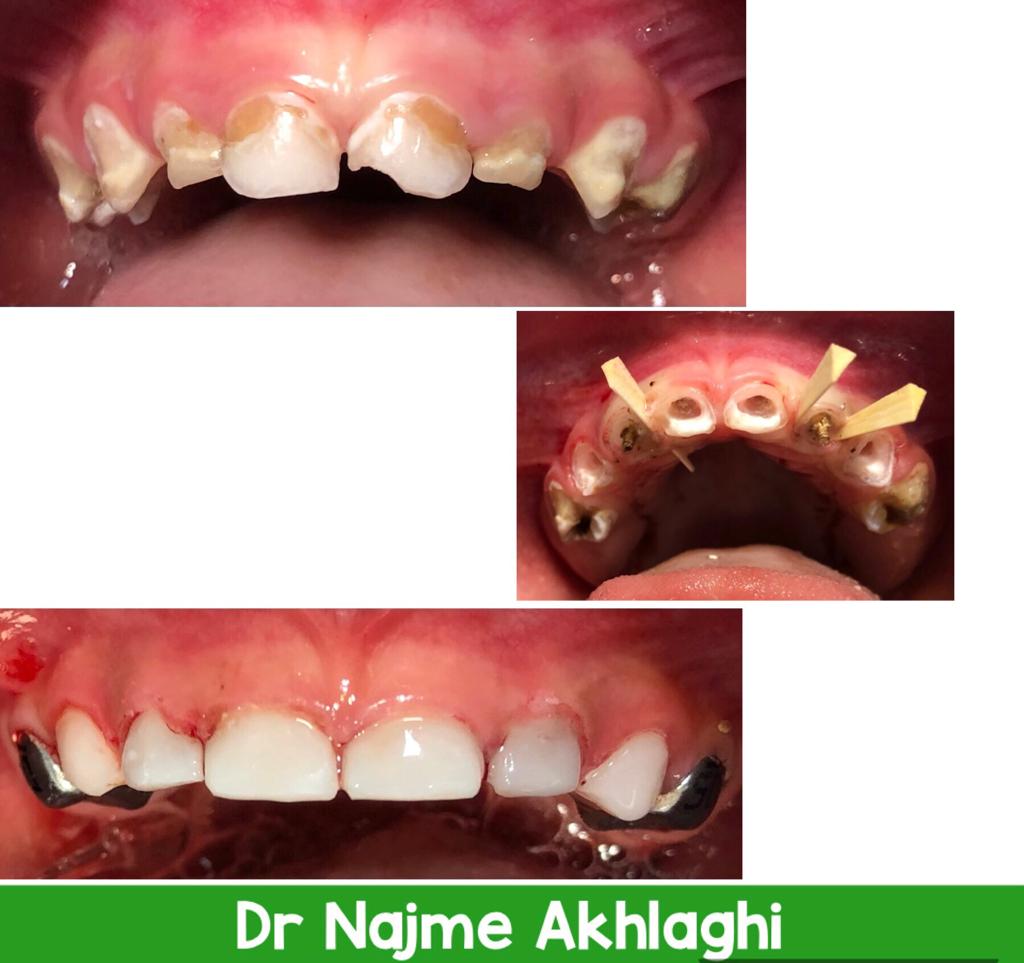 درمان ریشه و ترمیم دندانها ی جلو و عقب با بیهوشی | دندانپزشک کودکان اصفهان