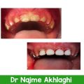 درمان ریشه و ترمیم دندانها | دندانپزشک کودکان اصفهان