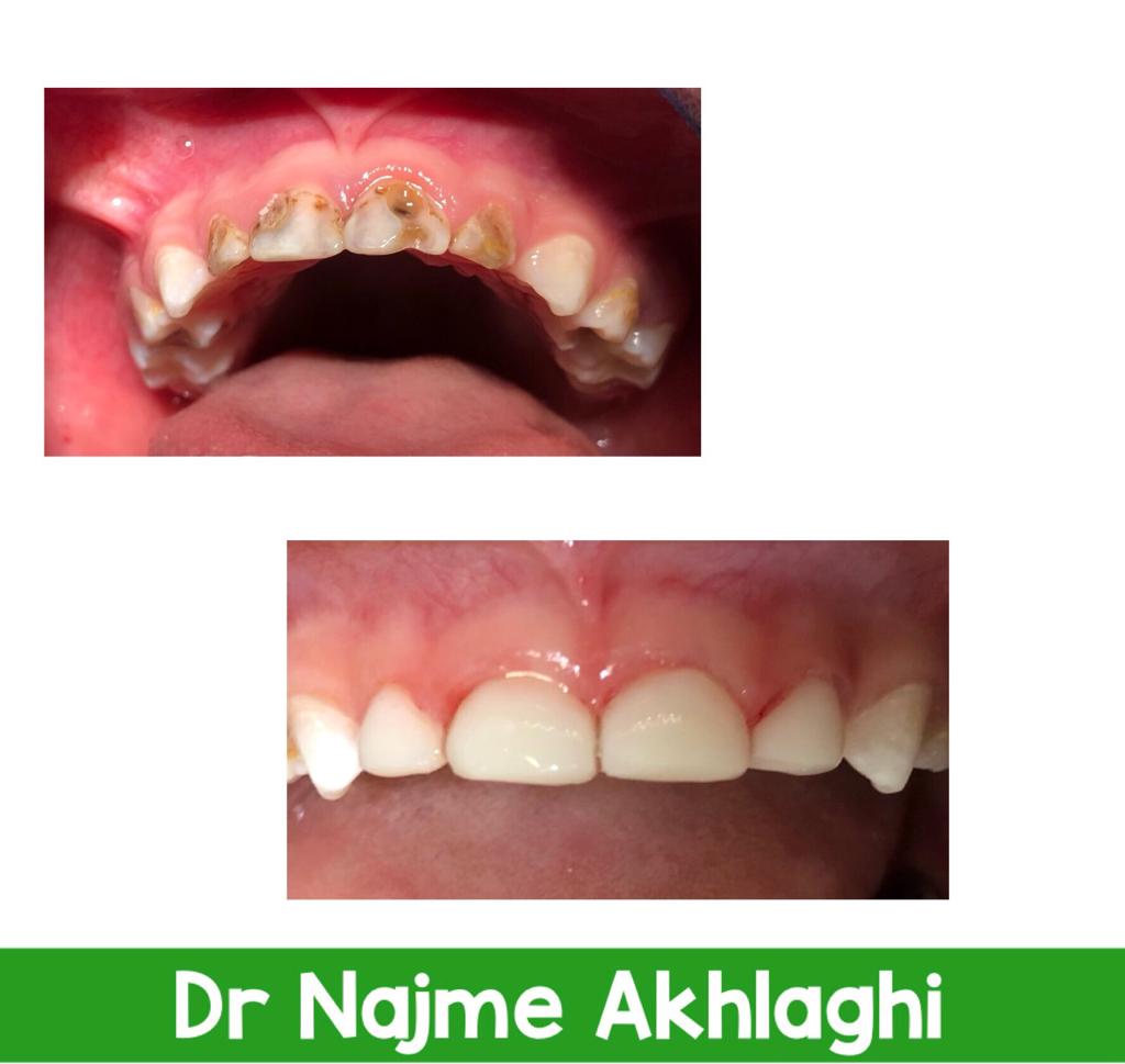 ترمیم و درمان ریشه دندانهای جلو با بیهوشی | دندانپزشک کودکان اصفهان