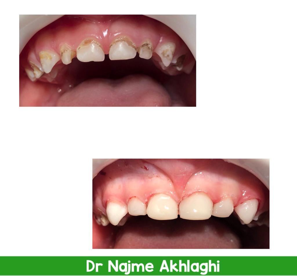 درمان ریشه و ترمیم کامپوزیت دندانهای جلو و درمان ریشه و روکش دندانهای خلفی با بیهوشی | دندانپزشک کودکان اصفهان