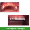 عصب کشی و ترمیم دندانهای جلوی شیری با بیهوشی | دندانپزشک کودکان اصفهان