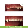 درمان ریشه و ترمیم دندانها | دندانپزشک کودکان اصفهان
