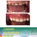 Root canal treatment and restoration | Isfahan Children's Dentist,,fa,What is pulp?,,fa,How to make a child happy with dentistry?,,fa,August 23,,fa