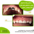 درمان ریشه و ترمیم زیبایی دندان