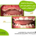 درمان ریشه و ترمیم زیبایی دندان های جلو و عقب