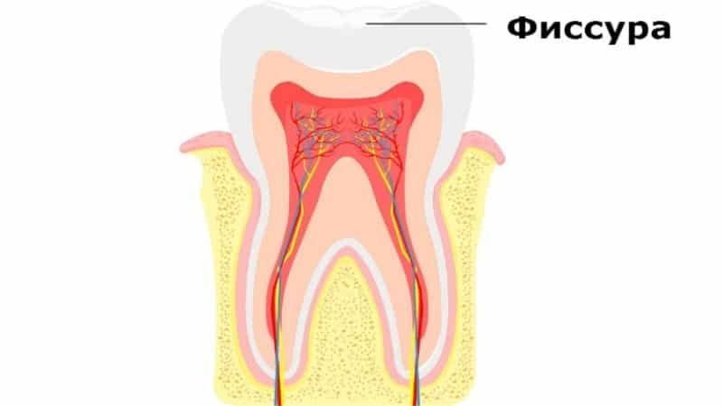 روش درمانی کانال ریشه چیست؟ | دندانپزشک کودکان اصفهان