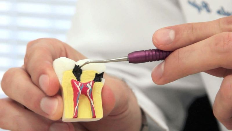 روش درمانی کانال ریشه چیست؟ | دندانپزشک کودکان اصفهان