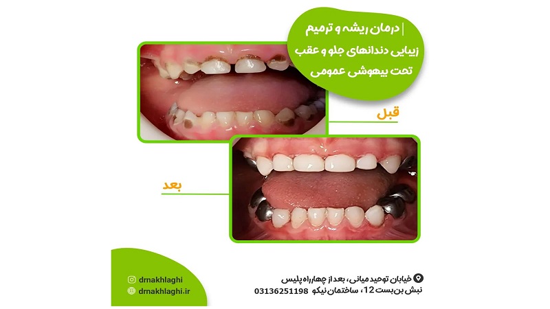 نمونه درمان ریشه دندان ها تحت بیهوشی عمومی