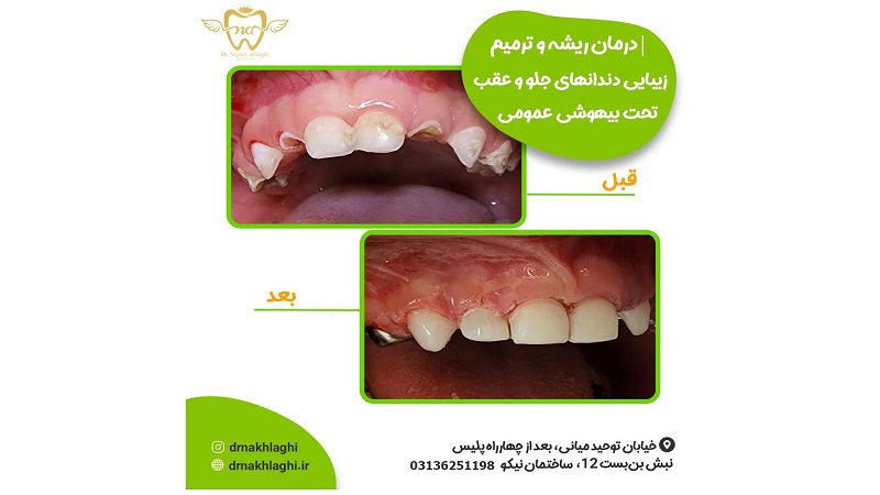 نمونه درمان ترمیم و زیبایی دندان تحت بیهوشی | دندانپزشک کودکان اصفهان