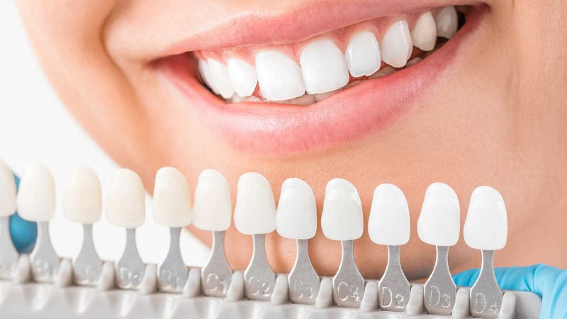 کاربرد انواع مختلف کامپوزیت دندان | دندانپزشک کودکان اصفهان