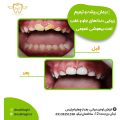 نمونه درمان پوسیدگی دندان کودک تحت بیهوشی | دندانپزشک کودکان اصفهان