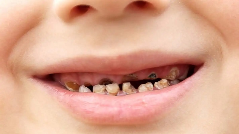 دلایل سیاهی دندان اطفال | دندانپزشک کودکان اصفهان