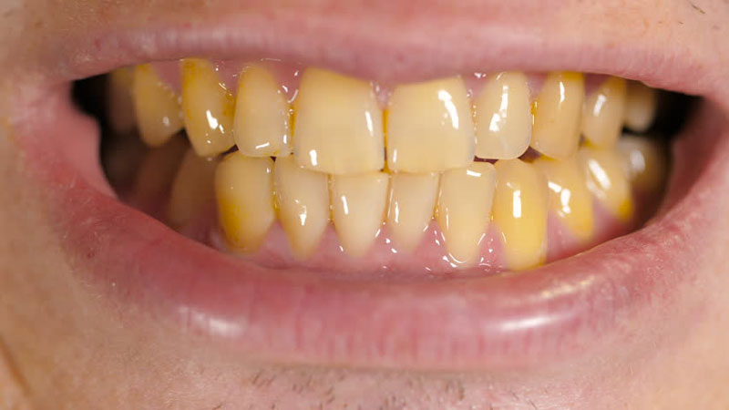 عوامل تغییر رنگ دندان | دندانپزشک کودکان اصفهان