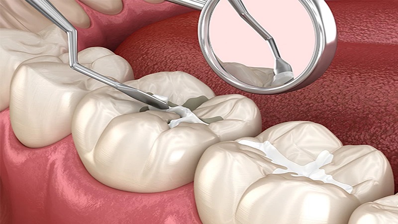 Advantages and disadvantages of fissure dental sealant | Isfahan Children's Dentist,,fa,What is pulp?,,fa,How to make a child happy with dentistry?,,fa,August 23,,fa