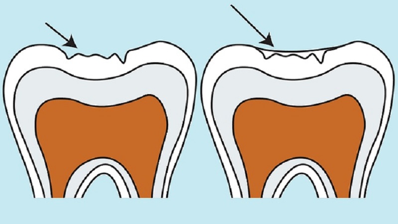 Advantages and disadvantages of fissure dental sealant | Isfahan Children's Dentist,,fa,What is pulp?,,fa,How to make a child happy with dentistry?,,fa,August 23,,fa