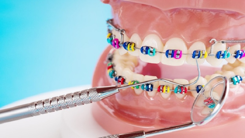 استفاده از بریس و ارتودنسی ثابت برای درمان آسیب دندان | دندانپزشک کودکان اصفهان