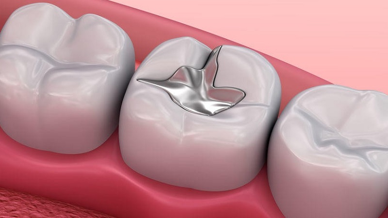 مزایا و معایب آمالگام (مواد نقره‌ای رنگ) | دندانپزشک کودکان اصفهان